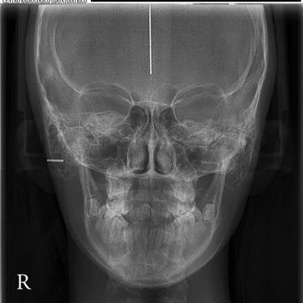 Radiografia seni mascellari