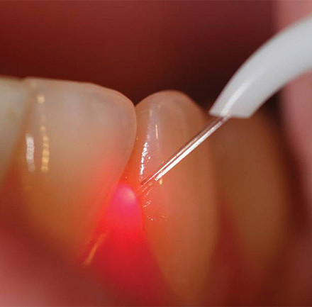 Terapie con Laser per patologie del cavo orale